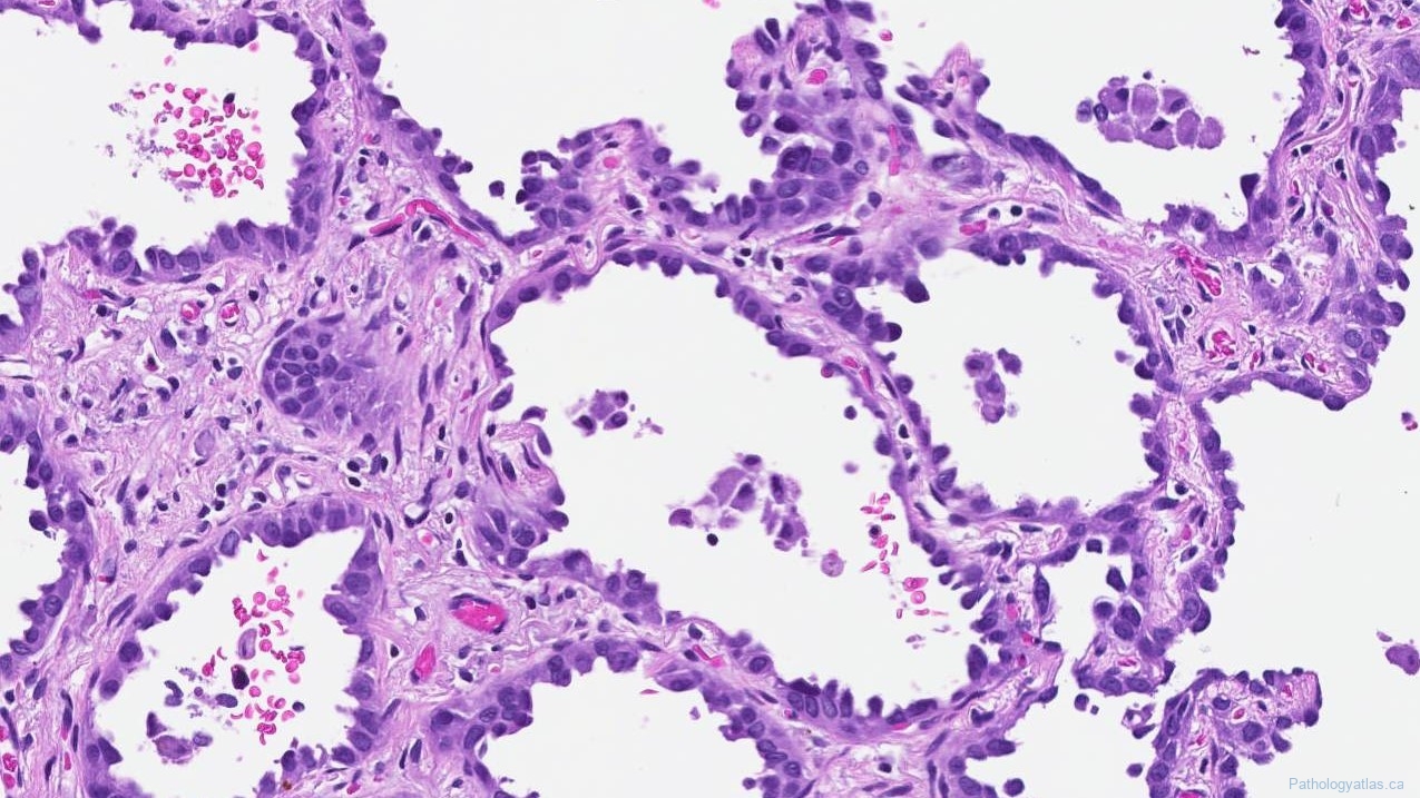 Adenocarcinoma Of The Lung Atlas Of Pathology