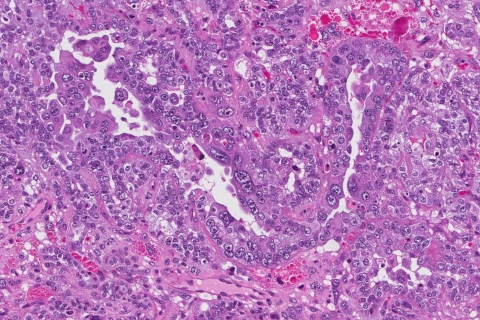 Carcinosarcoma Of The Uterus Ottawa Atlas Of Pathology