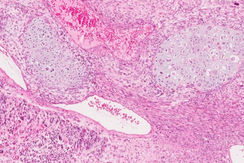 Carcinosarcoma Of The Uterus Ottawa Atlas Of Pathology