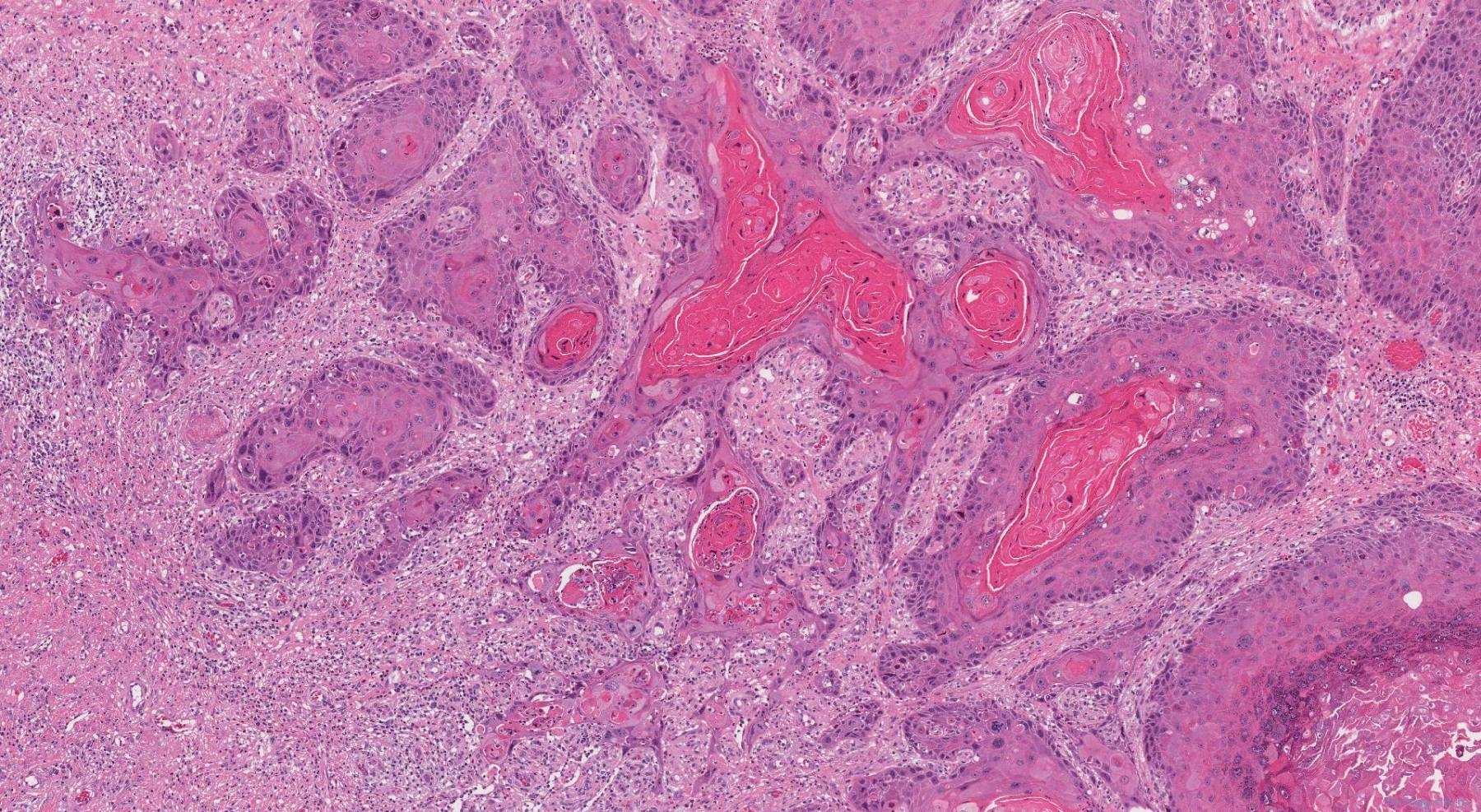 Pathologic Classification Of Squamous Cell Carcinoma Scc Of The Penis