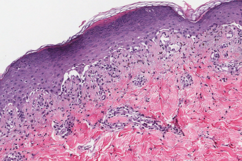 Interface Dermatitis Ottawa Atlas Of Pathology