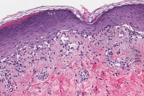 Interface Dermatitis Ottawa Atlas Of Pathology