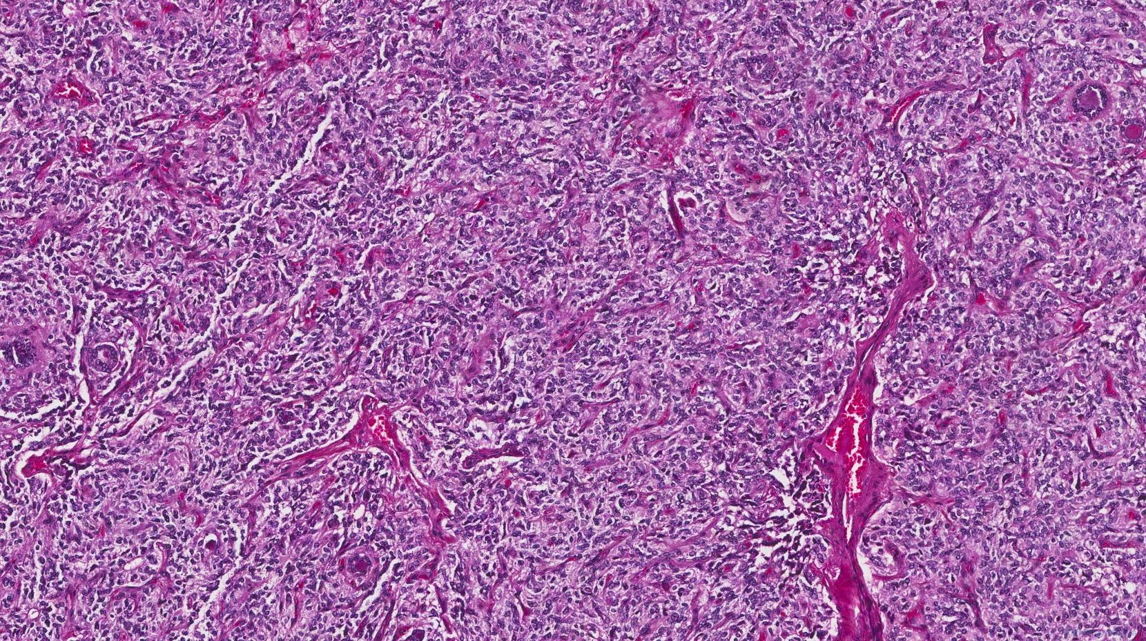 Medullary Thyroid Carcinoma Atlas Of Pathology