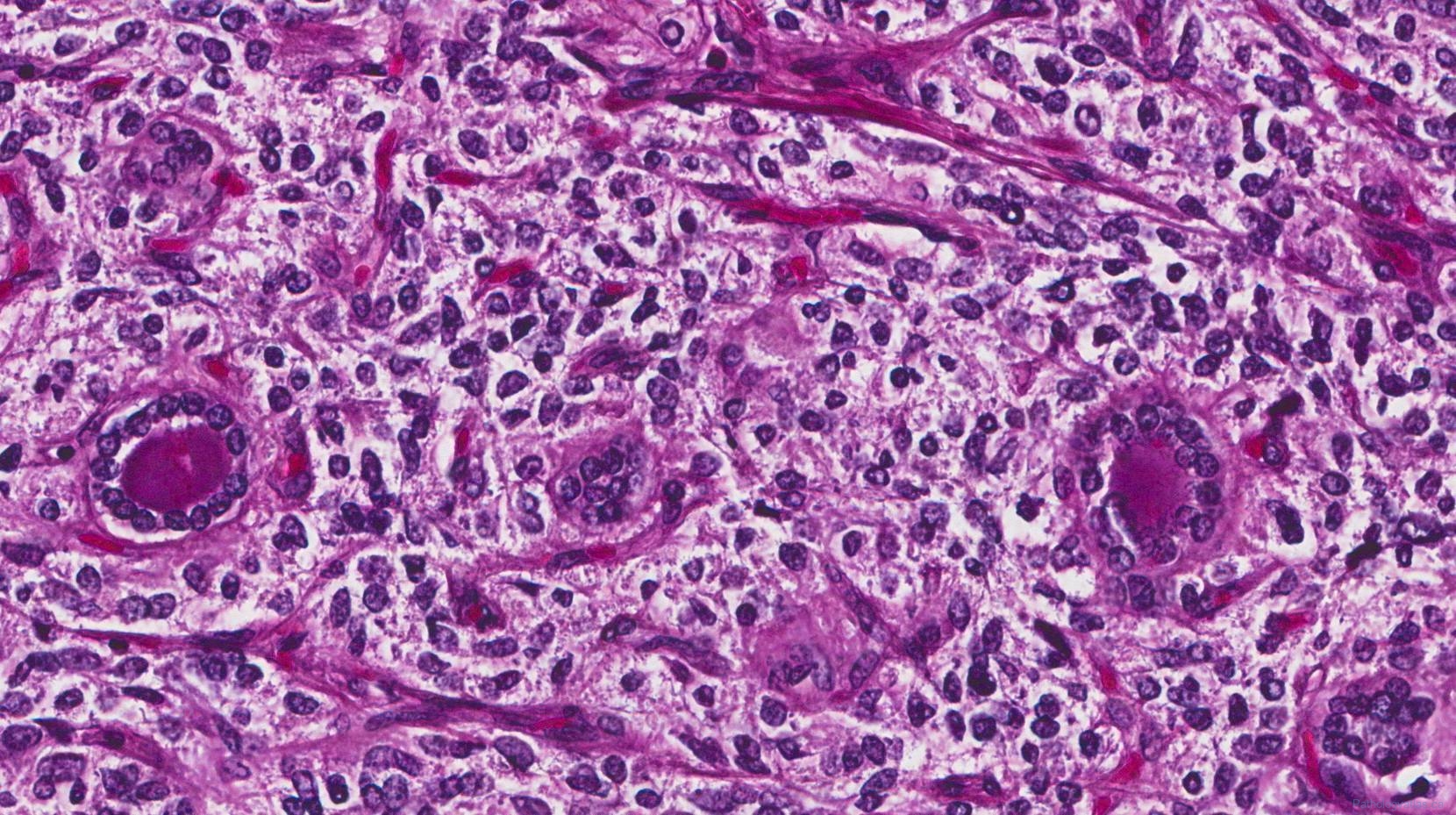 Medullary Thyroid Carcinoma Atlas Of Pathology