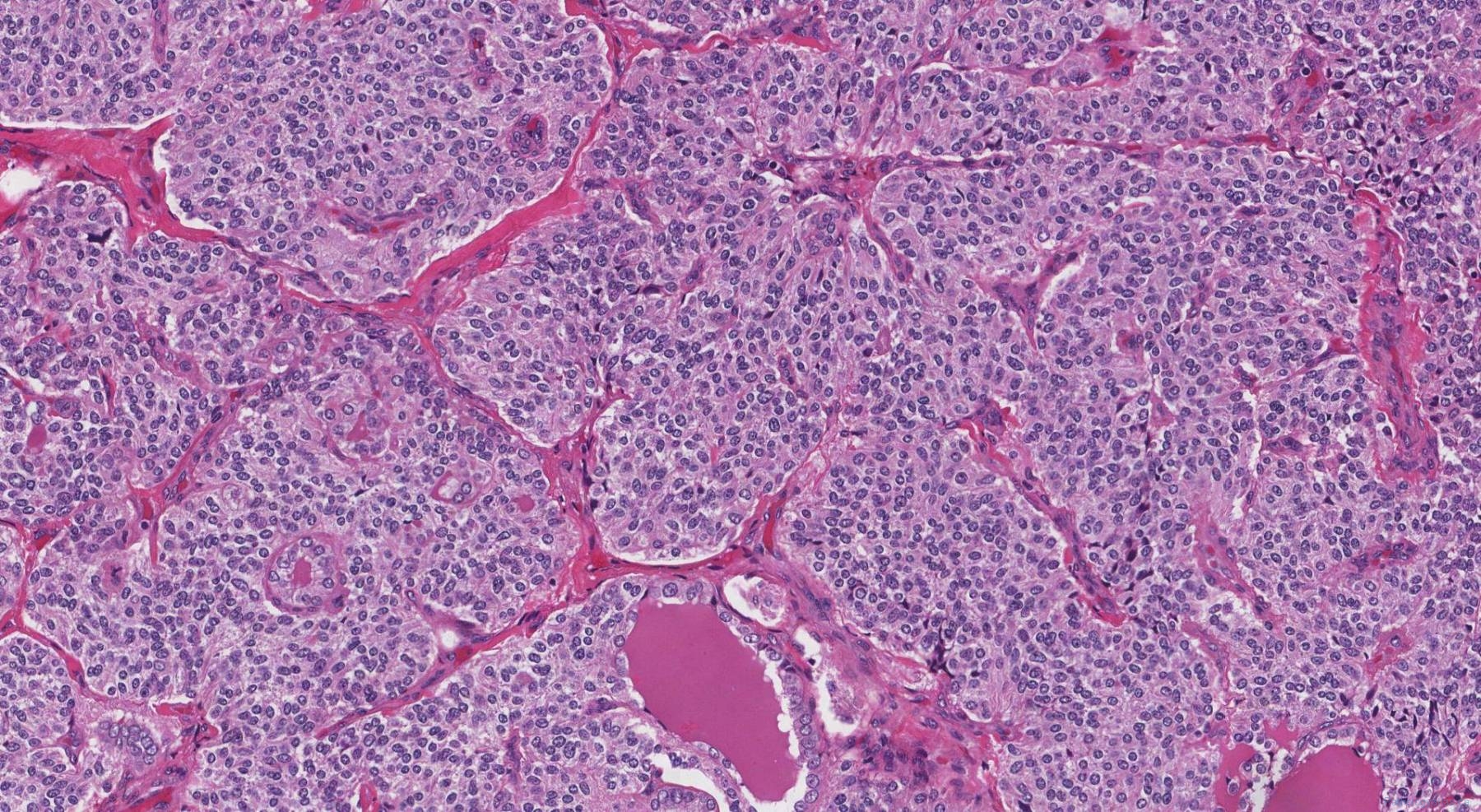 Medullary Thyroid Carcinoma Atlas Of Pathology