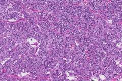 Medullary Thyroid Carcinoma Atlas Of Pathology