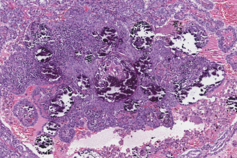 Papillary Thyroid Carcinoma Ottawa Atlas Of Pathology