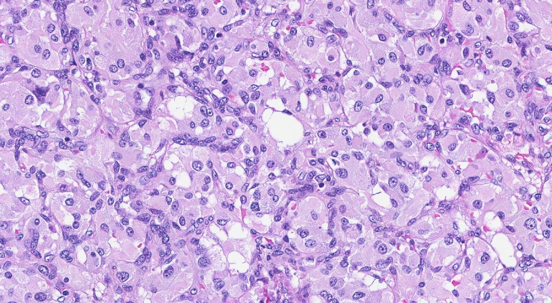 Paraganglioma Atlas Of Pathology