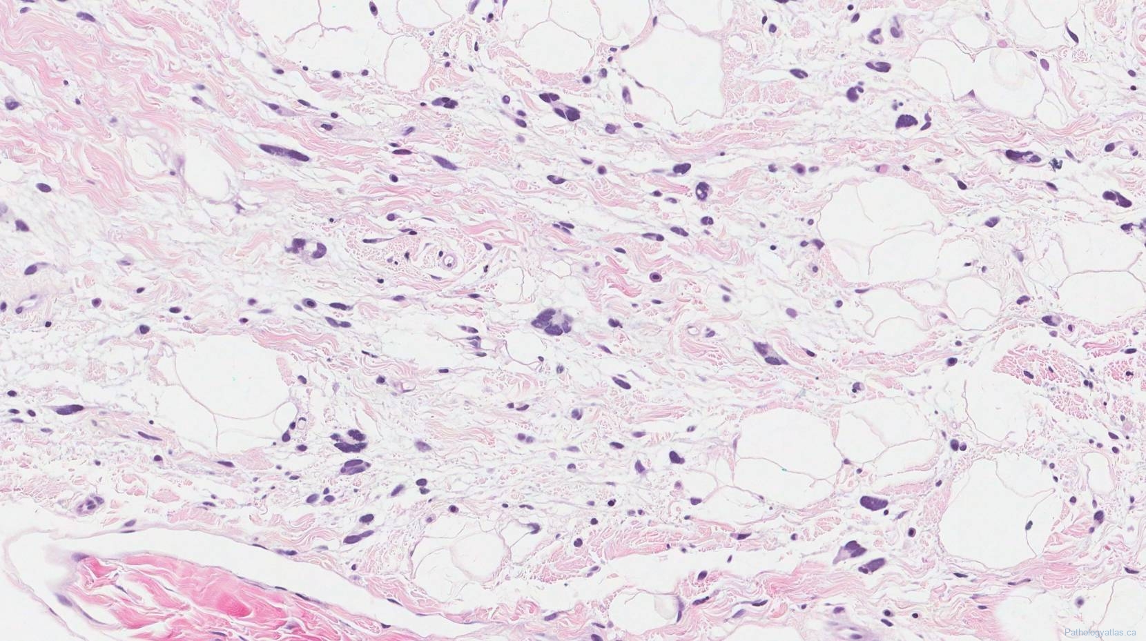 Pleomorphic Lipoma Atlas Of Pathology