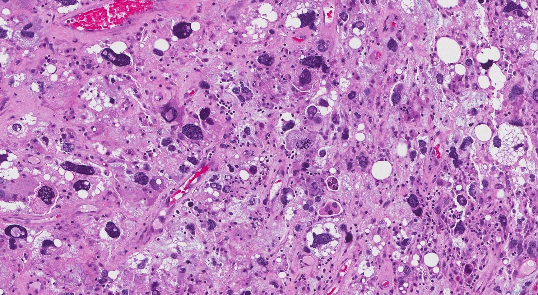 Pleomorphic Liposarcoma Atlas Of Pathology