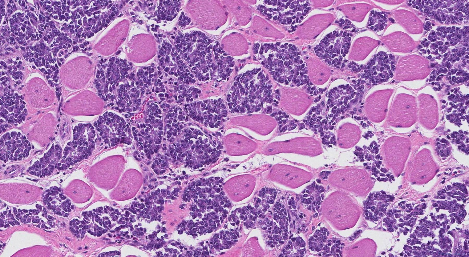 Primitive Neuroendocrine Tumour Atlas Of Pathology