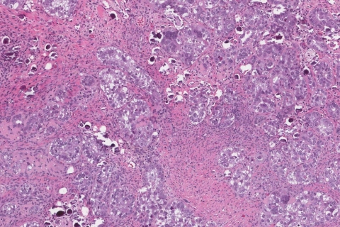 Serous Carcinoma Of The Uterus Ottawa Atlas Of Pathology