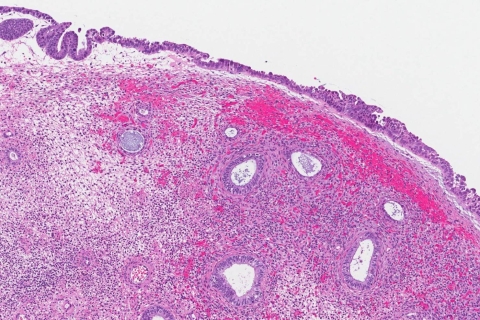 Serous Carcinoma Of The Uterus Ottawa Atlas Of Pathology