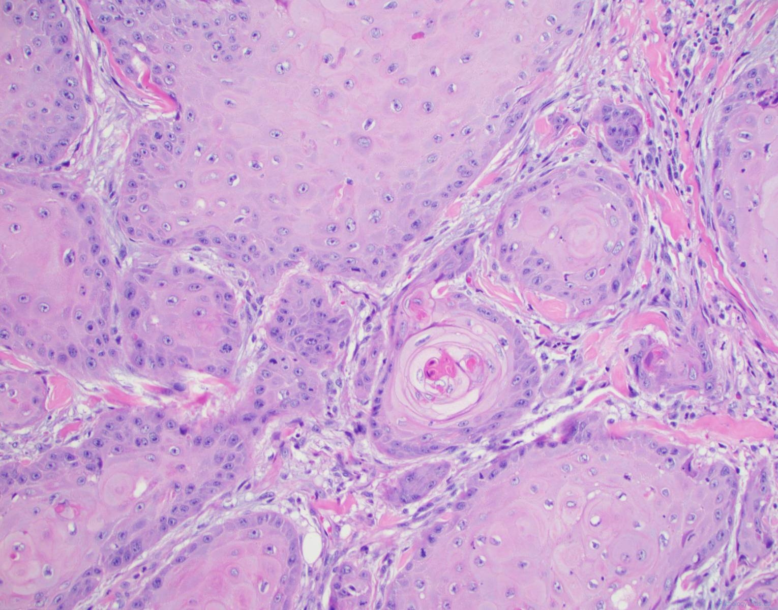 Squamous Cell Carcinoma Of The Vulva Ottawa Atlas Of Pathology