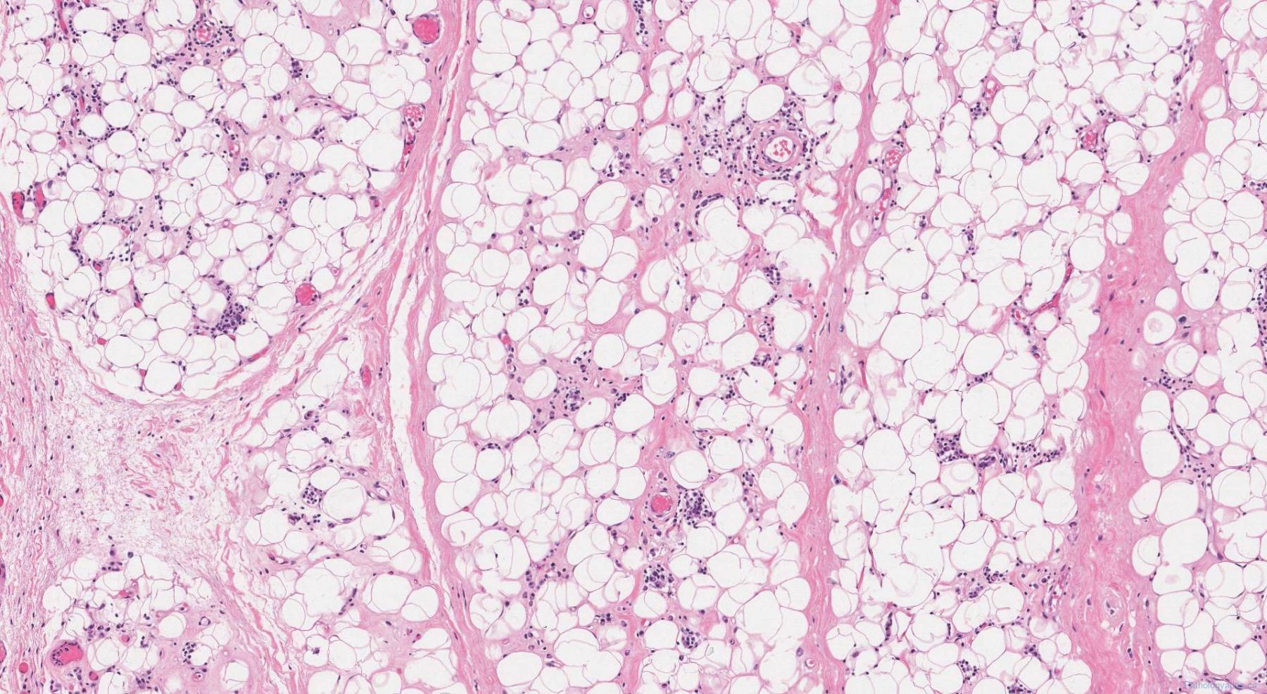 Well Differentiated Liposarcoma Atlas Of Pathology