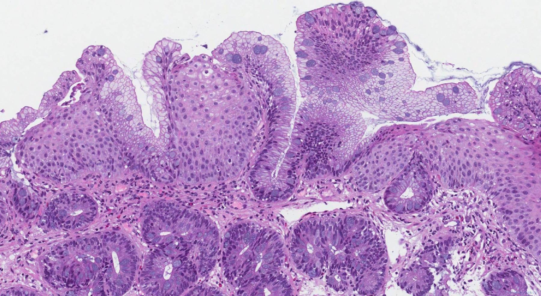 Esophagus Atlas Of Pathology