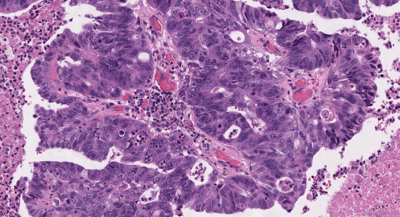 Nasal Cavity And Paranasal Sinuses Ottawa Atlas Of Pathology