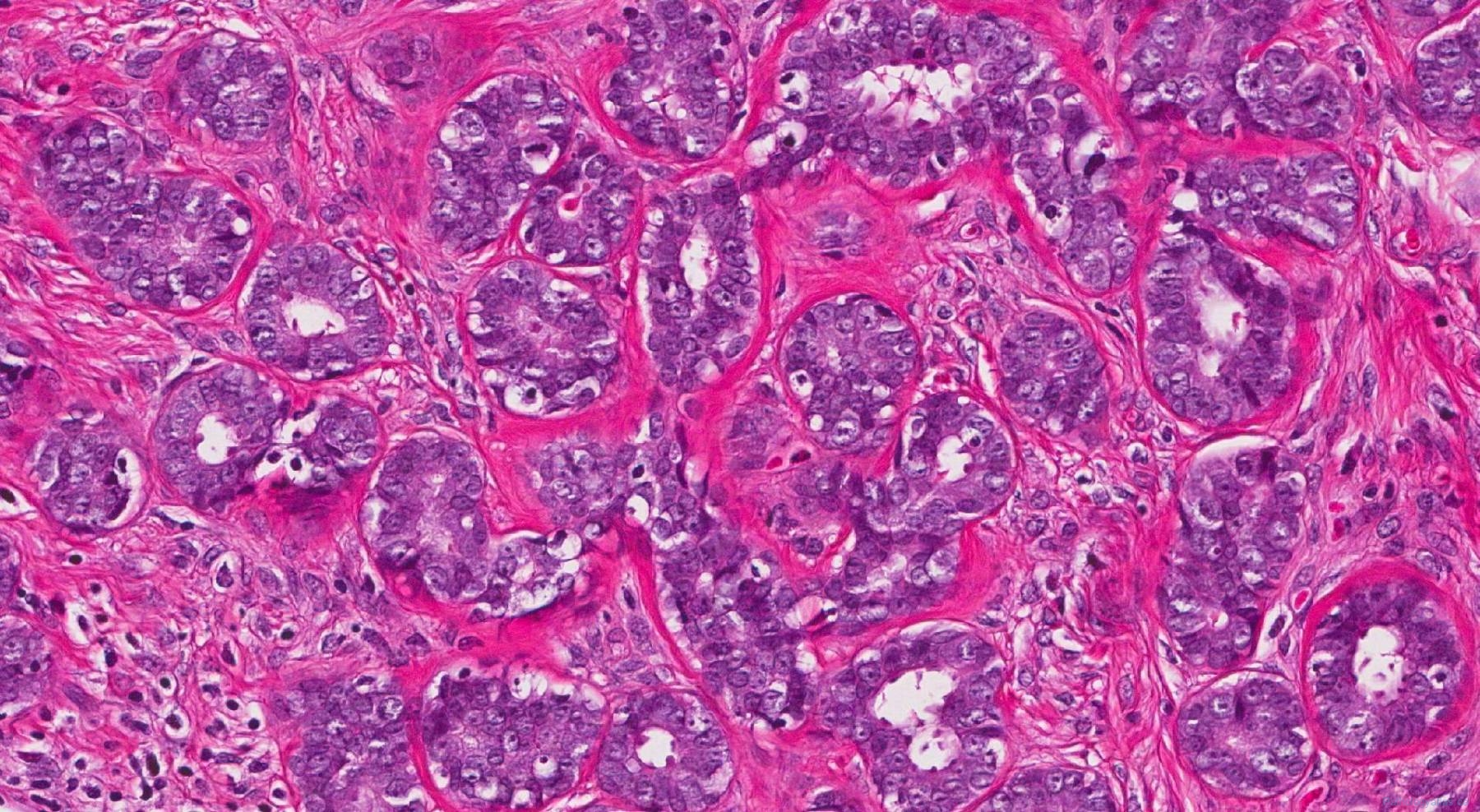 Juvenile Fibroadenoma Of The Breast Ottawa Atlas Of Pathology