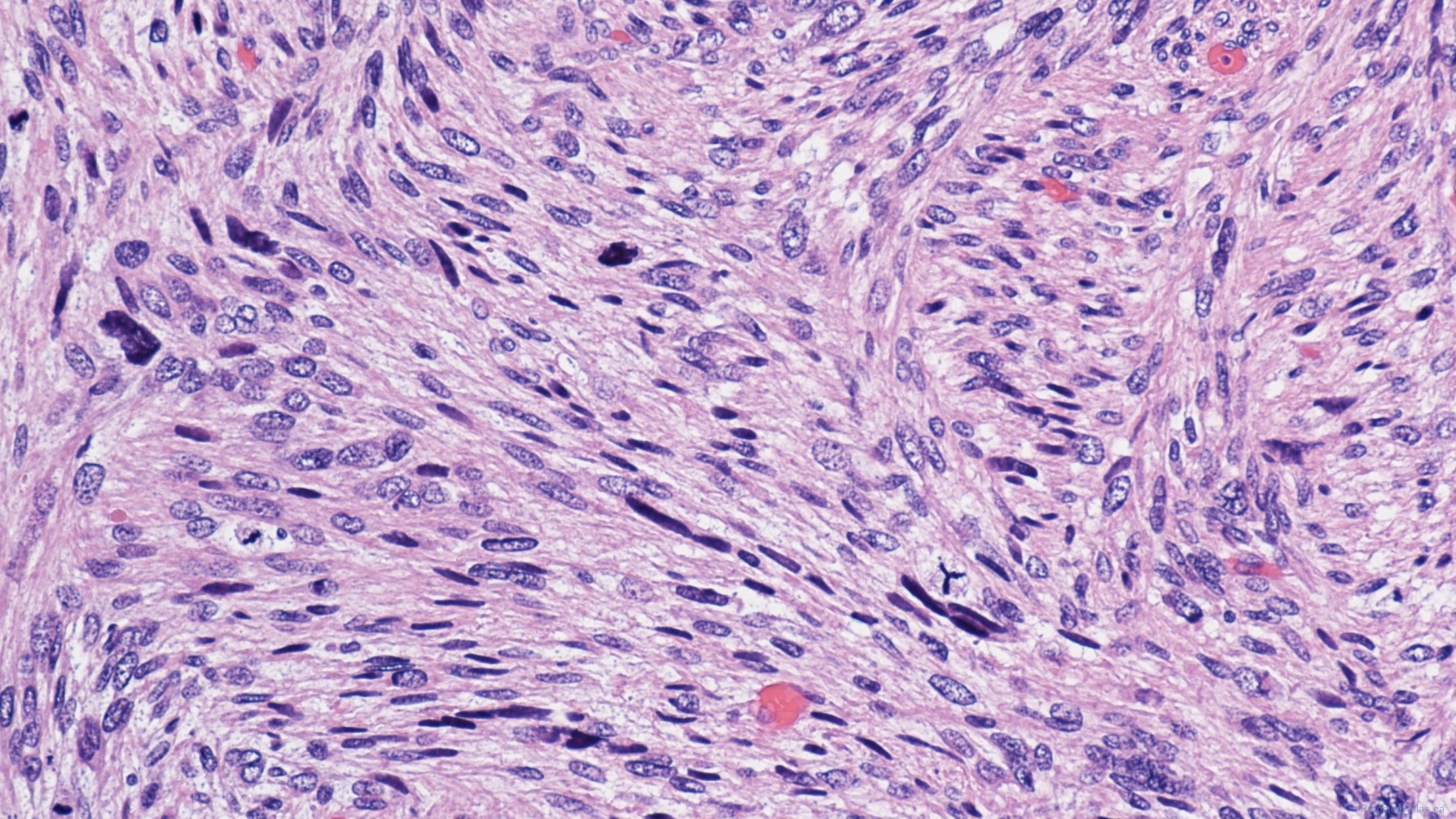 Leiomyosarcoma Ottawa Atlas Of Pathology