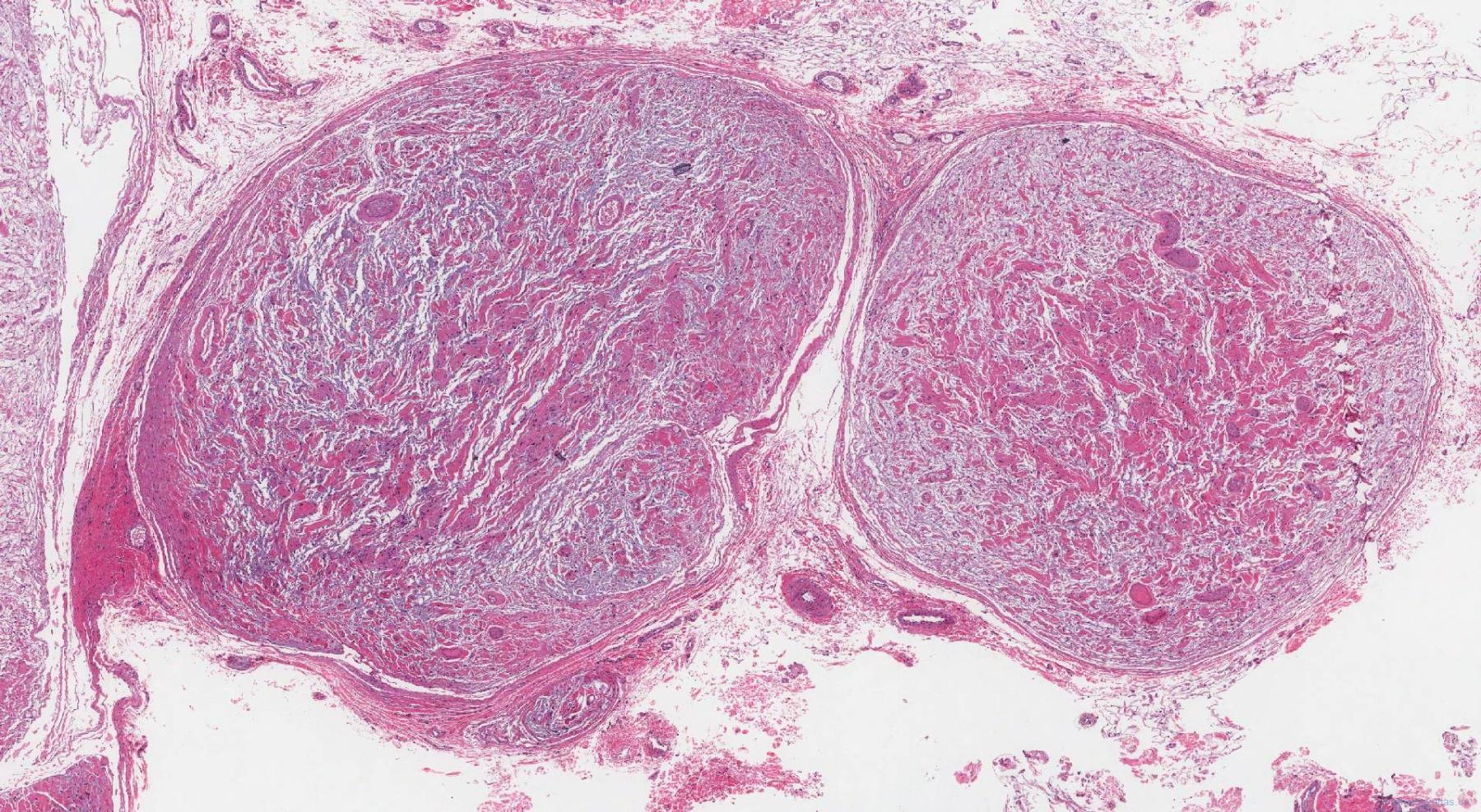 Plexiform Neurofibroma Ottawa Atlas Of Pathology