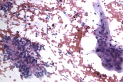 Mucinous adenocarcinoma