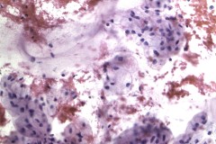 Mucinous adenocarcinoma