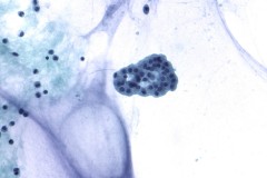 Pseudomyxoma peritonei