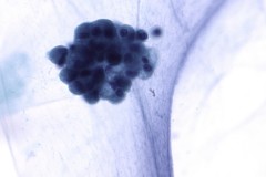 Pseudomyxoma peritonei