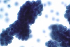 Peritoneal-fluid-MesotheliomaMesothelioma-SurePath-40X-4