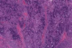 Acinic cell carcinoma with high grade transformation