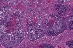 Acinic cell carcinoma with high grade transformation