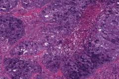 Acinic cell carcinoma with high grade transformation