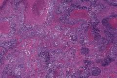 Acinic cell carcinoma with high grade transformation