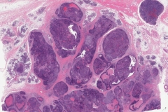 Acinic cell carcinoma with high grade transformation