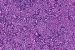 Acinic cell carcinoma with high grade transformation