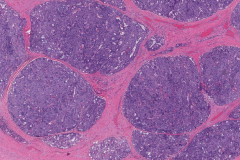 Acinic cell carcinoma