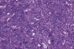 Acinic cell carcinoma