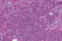 Acinic cell carcinoma with high grade transformation