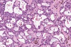 Acinic cell carcinoma