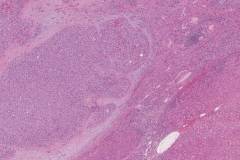 Metastatic acinic cell carcinoma of the parotid gland to the liver