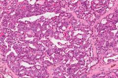 Acinic cell carcinoma