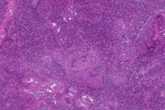 Acinic cell carcinoma