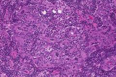 Acinic cell carcinoma