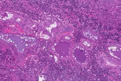 Acinic cell carcinoma