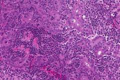 Acinic cell carcinoma