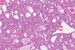 Acinic cell carcinoma