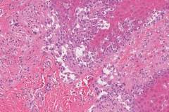 Acral melanoma