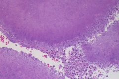 Actinomyces on the surface of the palatine tonsil