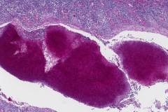 Actinomyces on the surface of the palatine tonsil