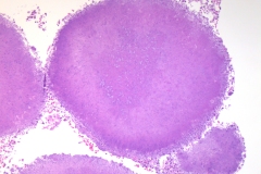 Actinomyces on the surface of the palatine tonsil